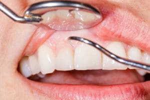 Periodic dental examination to have a healthy mouth and teeth.