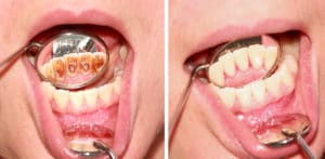 Before and after removal of tartar. Reflection in the mirror.