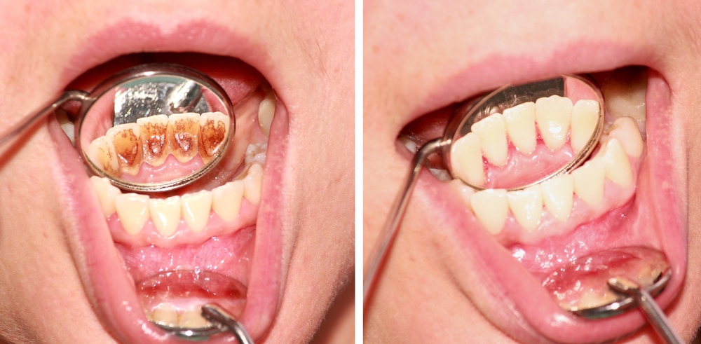 Before and after removal of tartar. Reflection in the mirror.