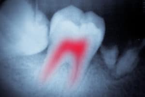 Dental X Ray for Root Canal